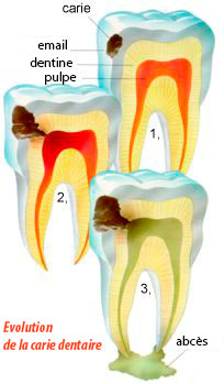 Traitement de la Carie